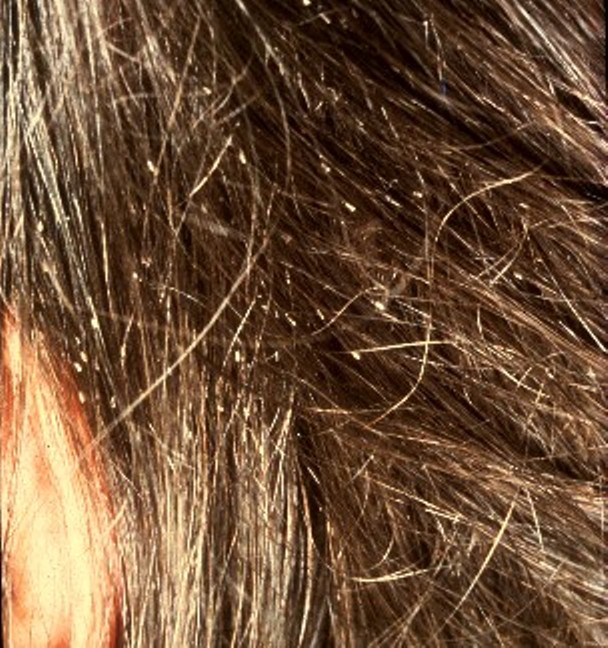 In home Head Lice Removal Service Baby Angel Hair in-home-head-lice-removal-service-baby-angel-hair